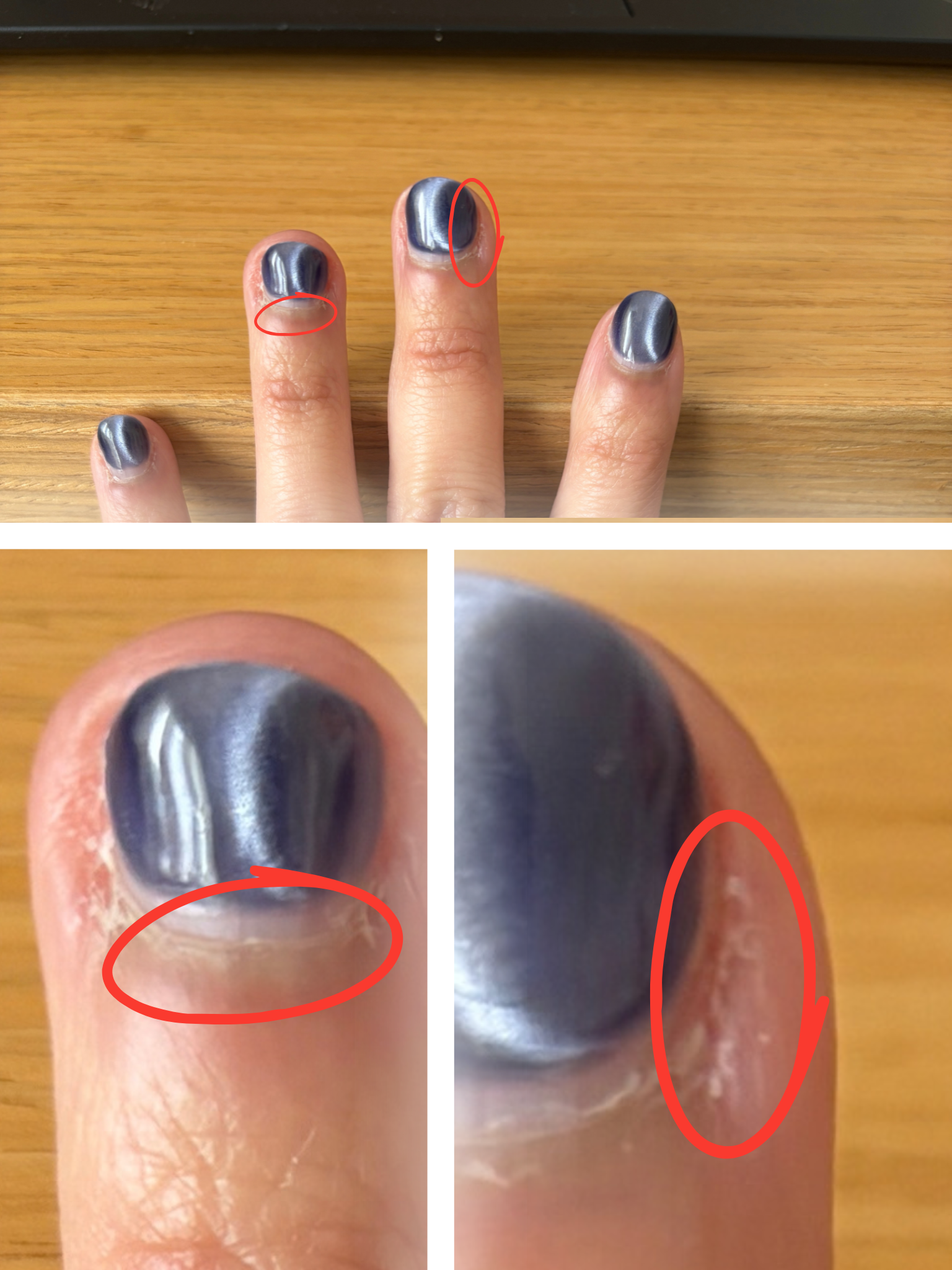 A zoomed in photo of two nails, showing overgrown hardened skin and thick, unmanaged eponychium.