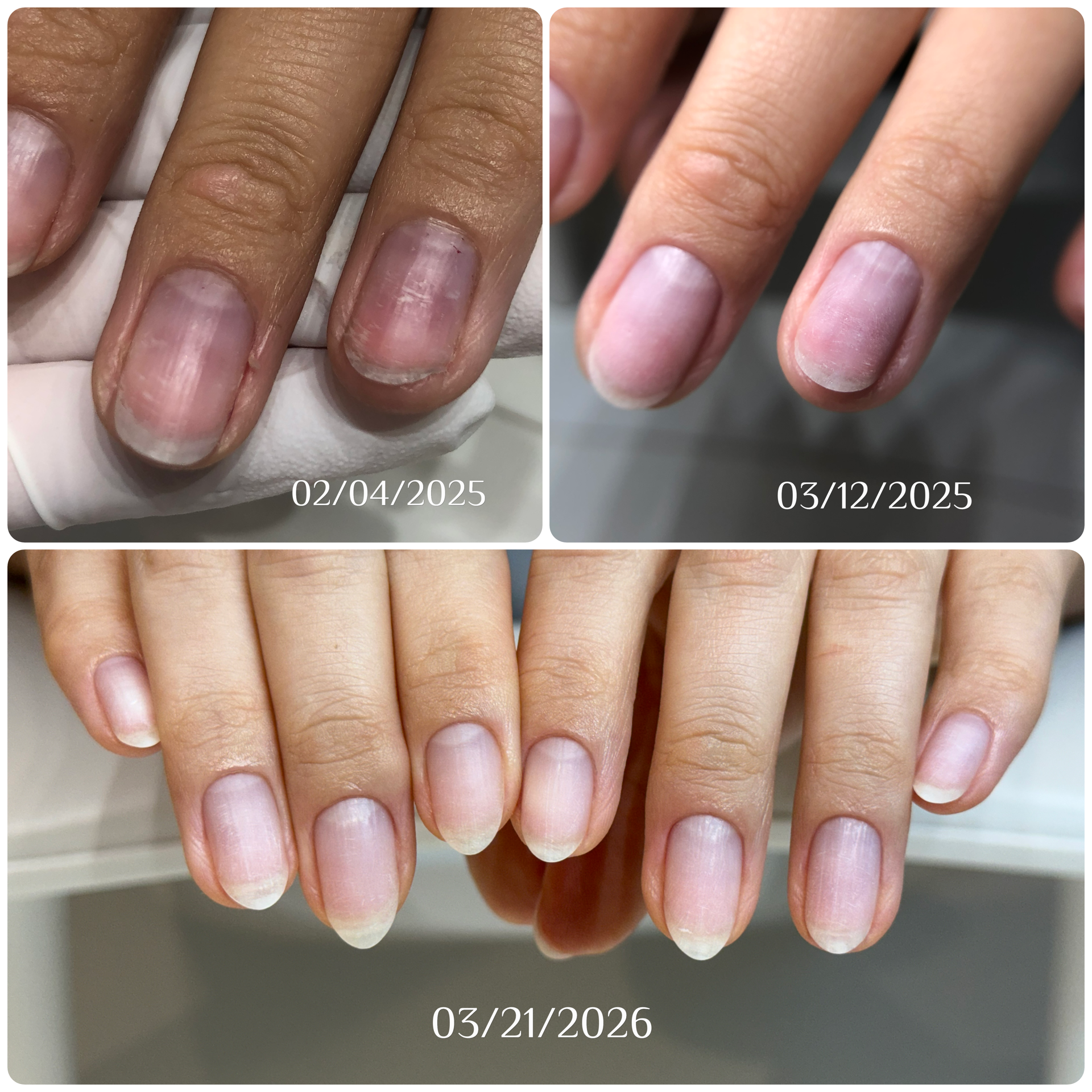 Nail care progress, showing inflamed, damaged nails transforming into beautiful, healthy, and strong nails at Atelier Anaiis.
