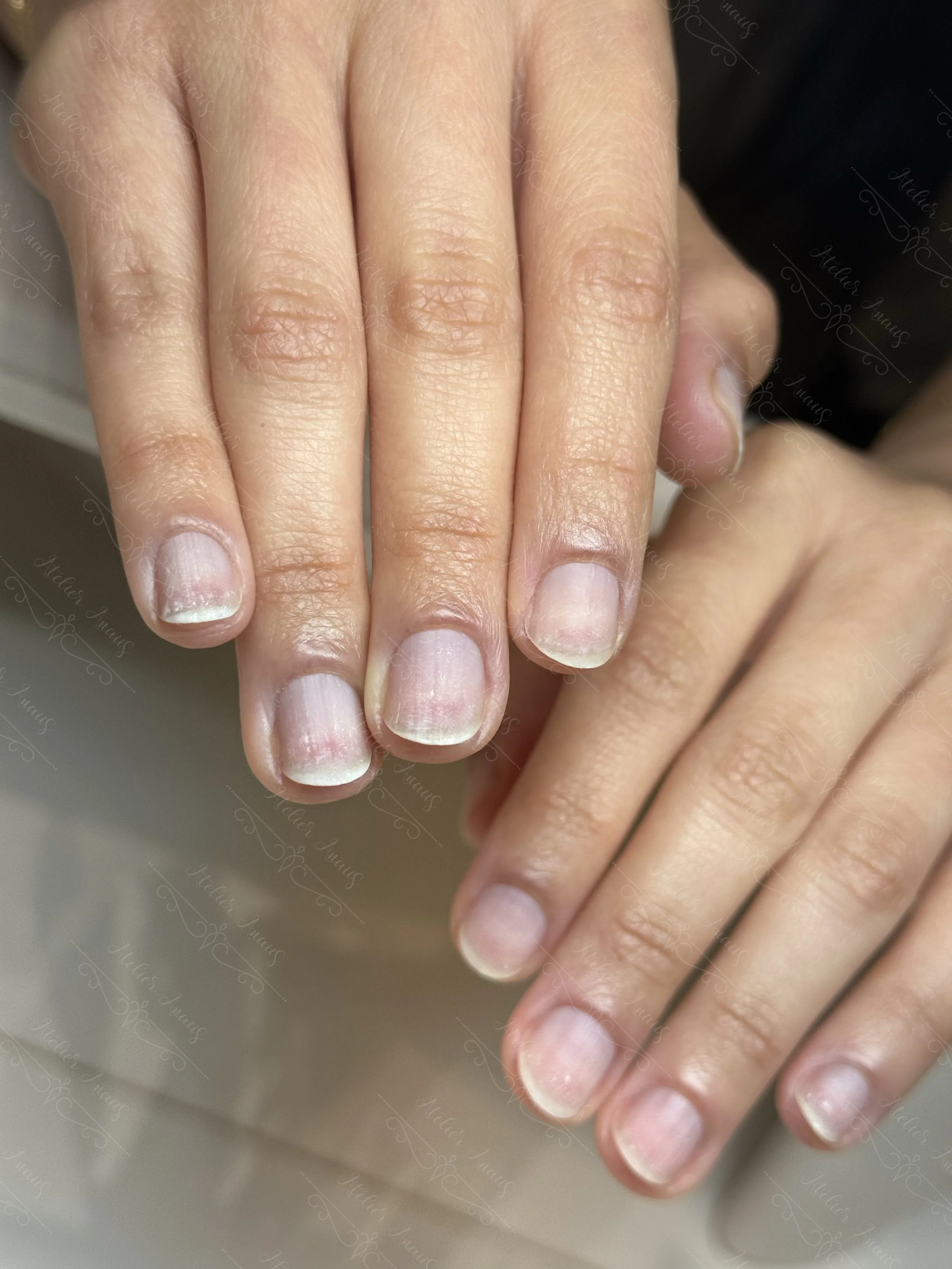 Nails showing remarkable improvement after just two appointments, with improved color, less bruising, and healthier skin.
