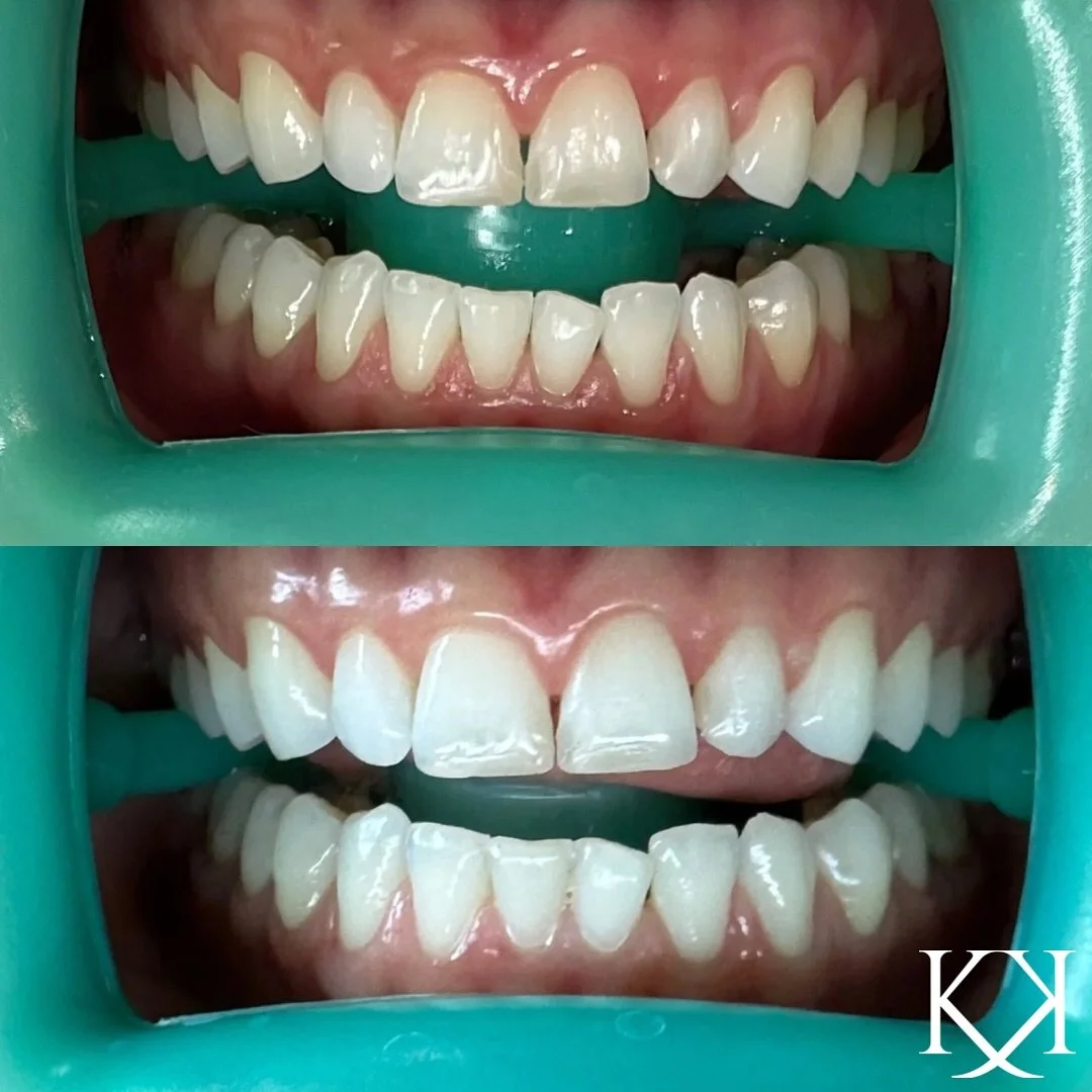 ✨ Nothing beats a fresh, confident smile ✨
Check out these amazing before & after results from our professional teeth whitening service! Up to 10 shades brighter in just one session. Ready to glow from your smile to your skin? Book your appointme