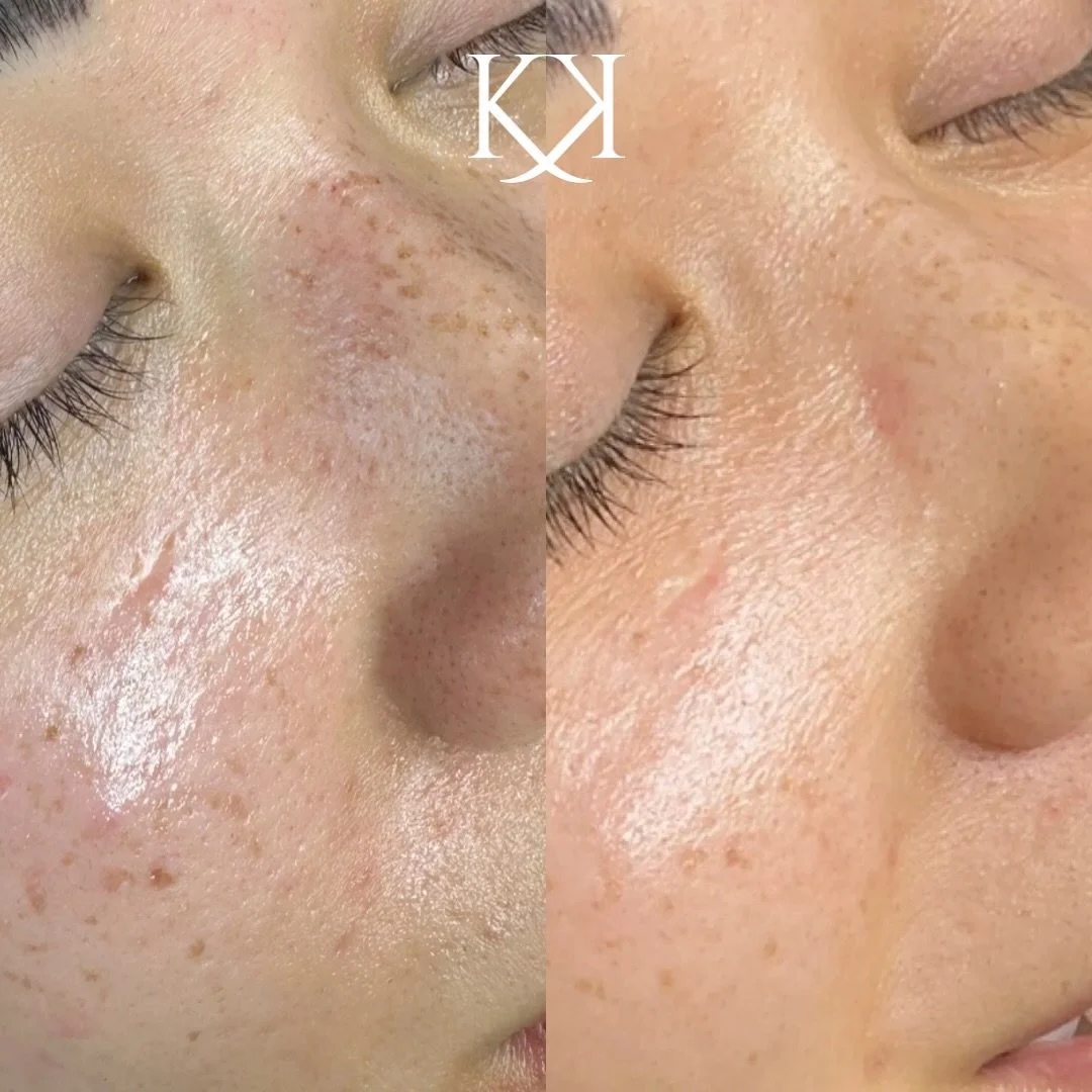 Skin so clear I gotta say&hellip; move, B$tch&mdash; get out the way 💅
When you finally commit to your custom routine + treatment plan, the glow hits different.
Wanna know how to get results like this? Book your consultation today and start seeing r