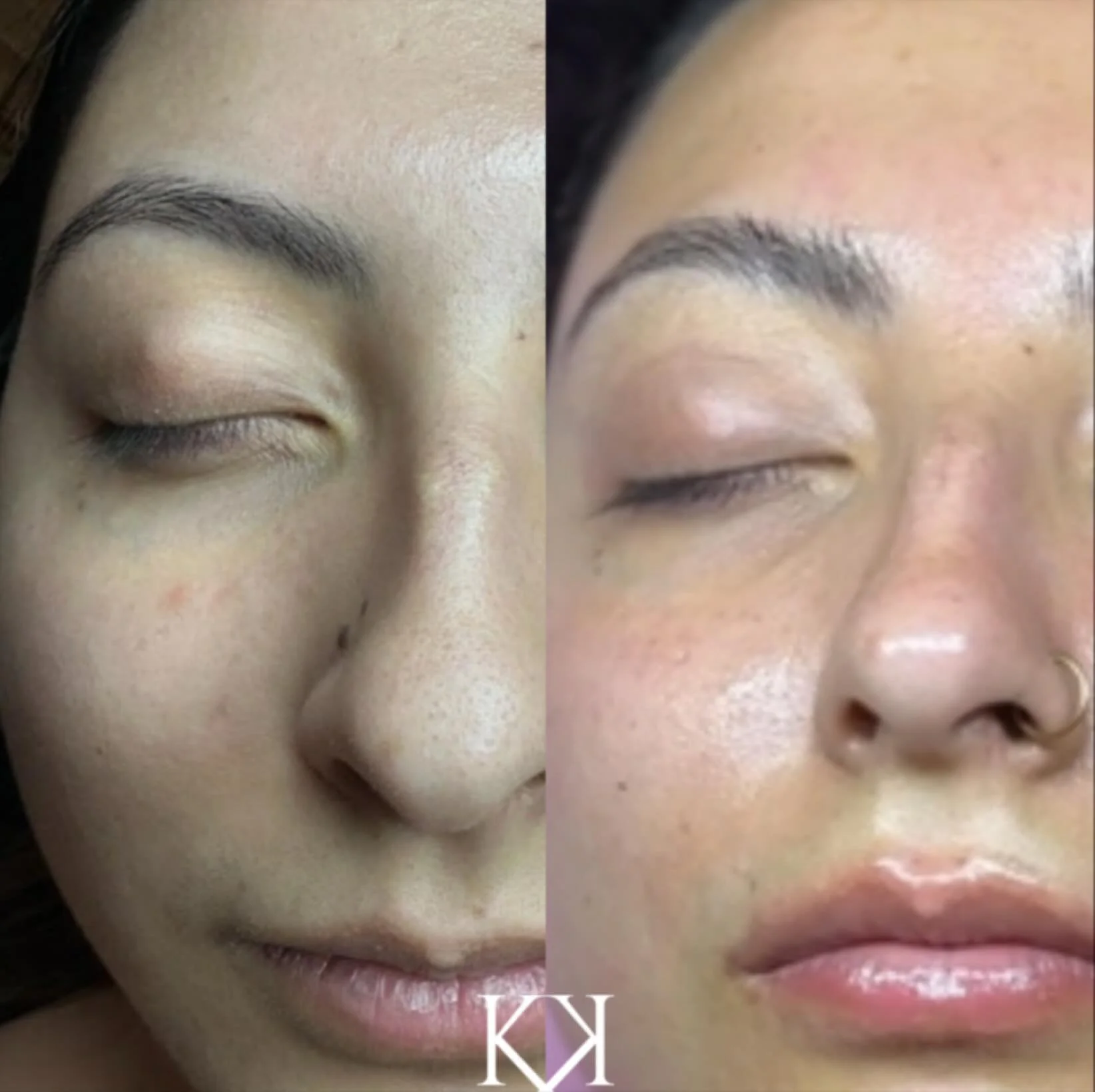 ✨ Clear Skin Is a Team Effort ✨

This beauty and I have been doing trades for almost two years, and her results speak for themselves. With consistent home care, calming treatments, and treatments focused on smoothing texture, reducing congestion arou