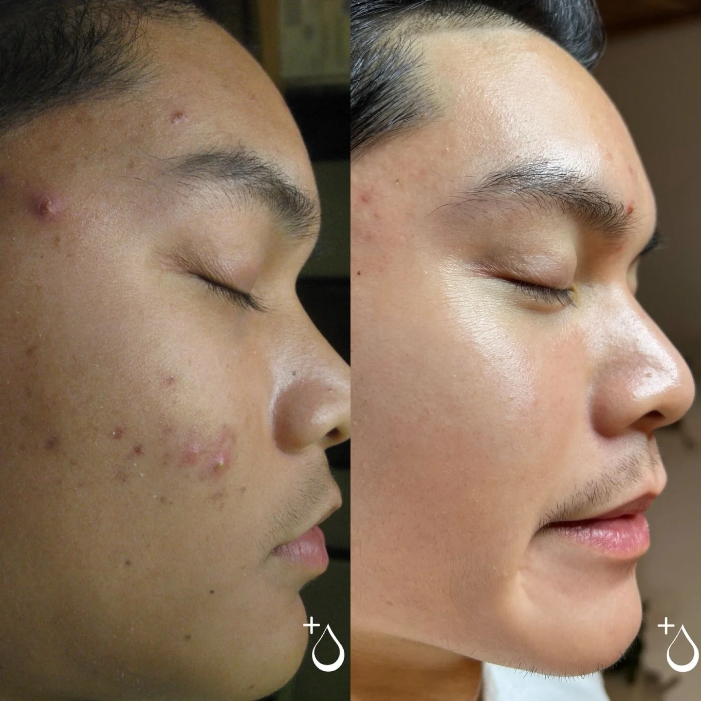 🌟 ACNE MODEL CALL: JOIN OUR EXCLUSIVE ACNE BOOTCAMP! 🌟

Are you ready to finally clear your skin? We&rsquo;re looking for a small group of dedicated acne clients to join our inaugural Acne Bootcamp and model their stunning transformation!

WHAT YOU