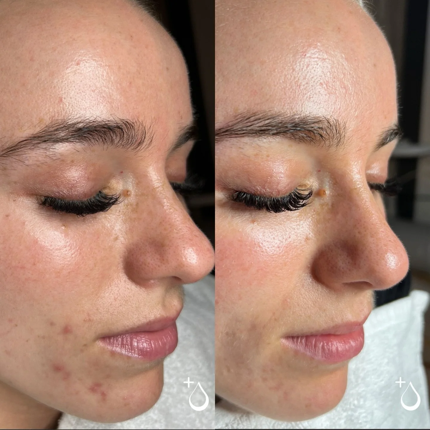 🌟 ACNE MODEL CALL: JOIN OUR EXCLUSIVE ACNE BOOTCAMP! 🌟

Are you ready to finally clear your skin? We&rsquo;re looking for a small group of dedicated acne clients to join our inaugural Acne Bootcamp and model their stunning transformation!

WHAT YOU