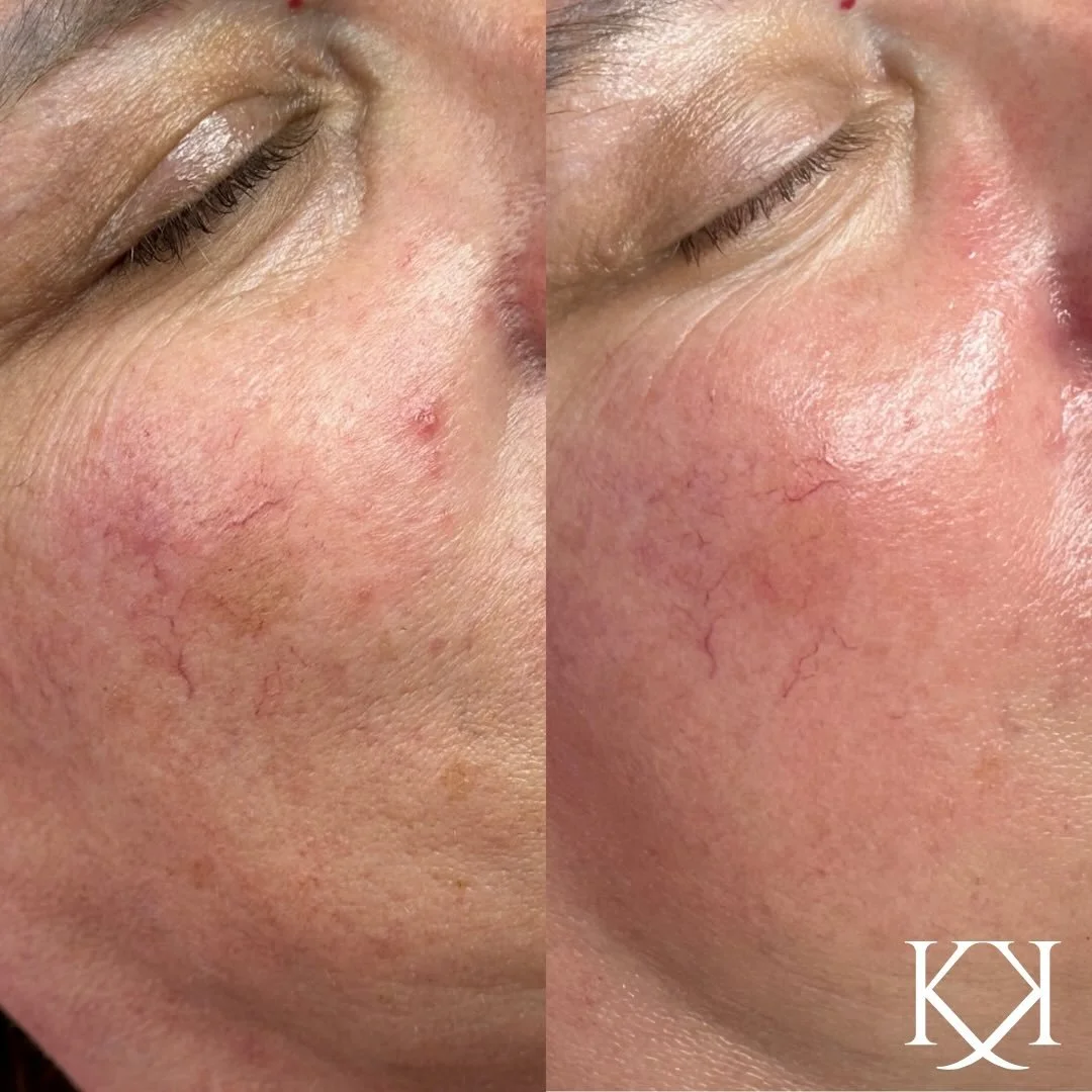 I see my mom every single day&hellip; so sometimes I forget just how much real change we&rsquo;ve made in her skin. 🤯 Today I got a 1-year reminder on my phone and when I put the before &amp; afters together, my jaw dropped.

Look at the difference 