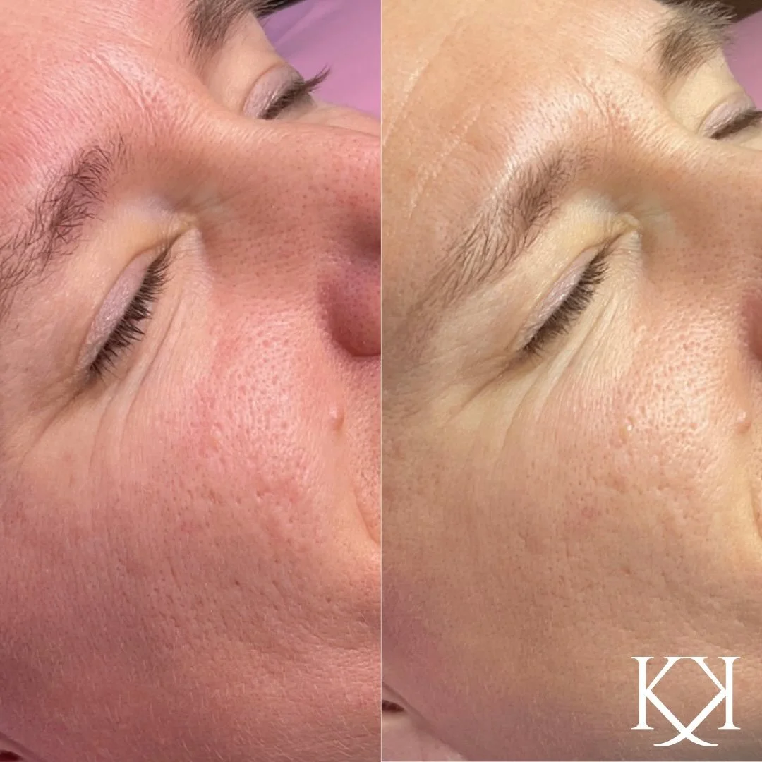 The results are in, and they are incredible. ✨

After just 4 BioRePeel Blue treatments, and of course home care we are seeing a total skin transformation. Swipe to see the difference! ➡️

✅ Smoother, refined skin texture
✅ Diminished pigmentation
✅ A