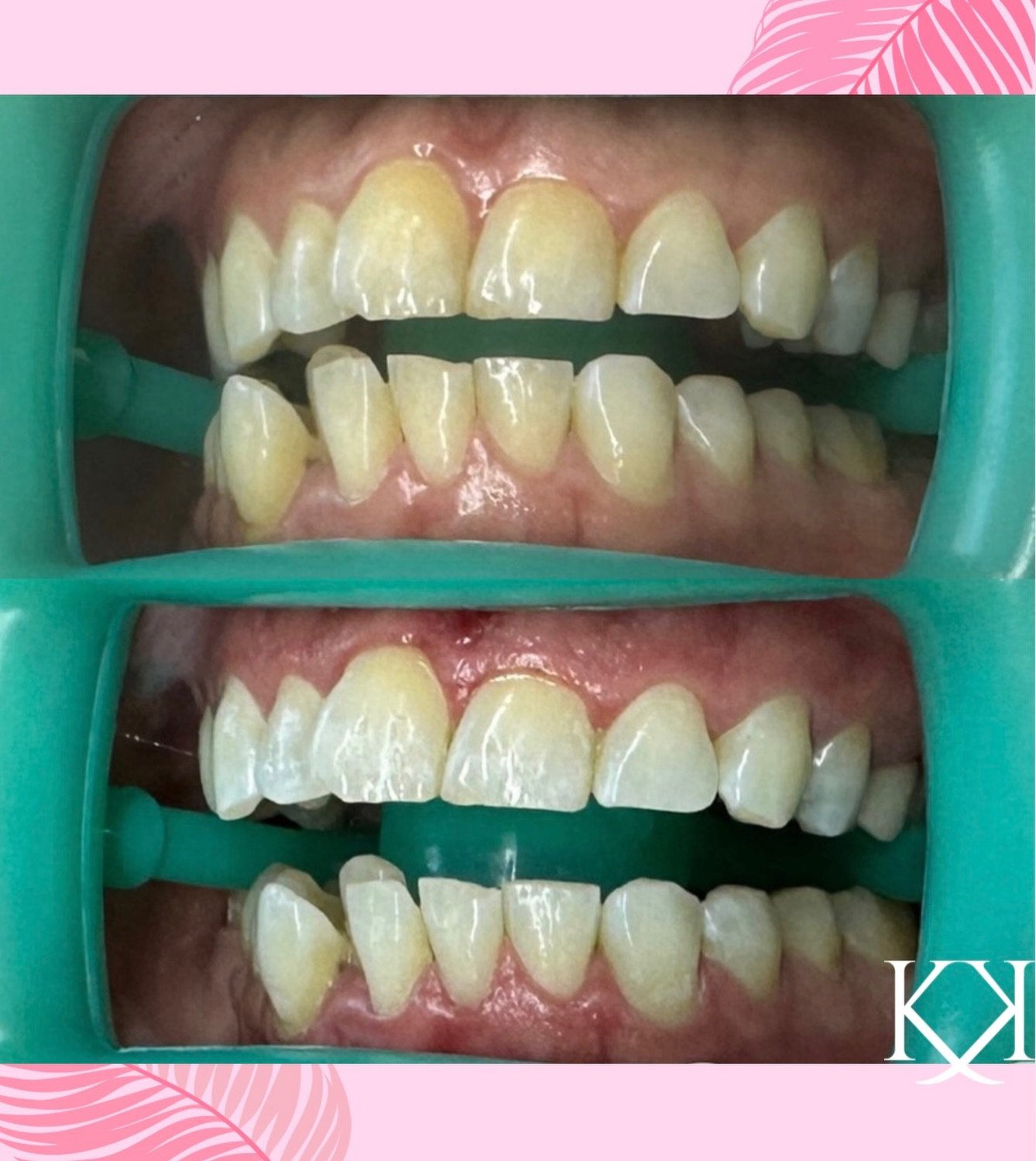 90 minutes. One session. Major difference 😌✨

This before + after was achieved using my 35% hydrogen peroxide whitening gel for a noticeably brighter smile in just one appointment.

Fast, effective, and giving these teeth the glow-up they came for ?