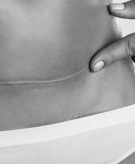C-Section Scar Release: The Missing Step From Most Recoveries