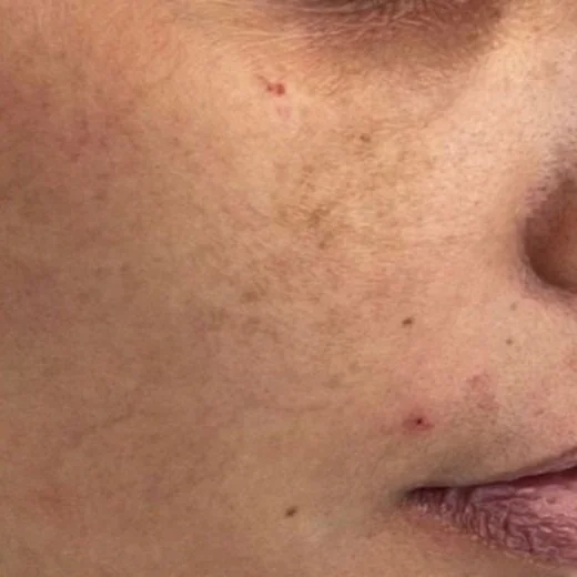 Melasma After