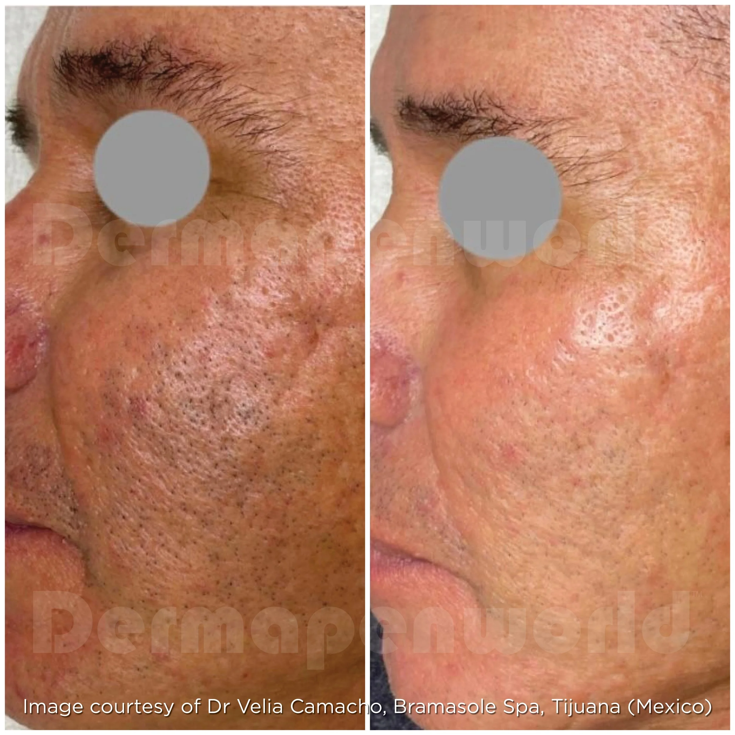 Exo-Skin Treatment Results - Scarring