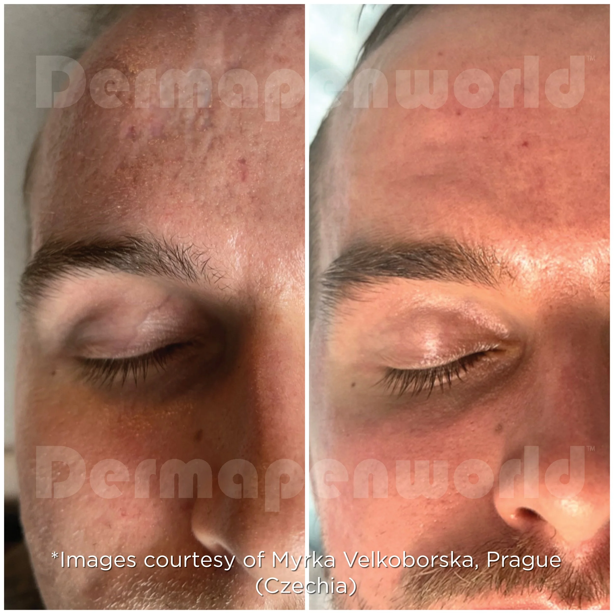 Exo-Skin Treatment Results - Scarring