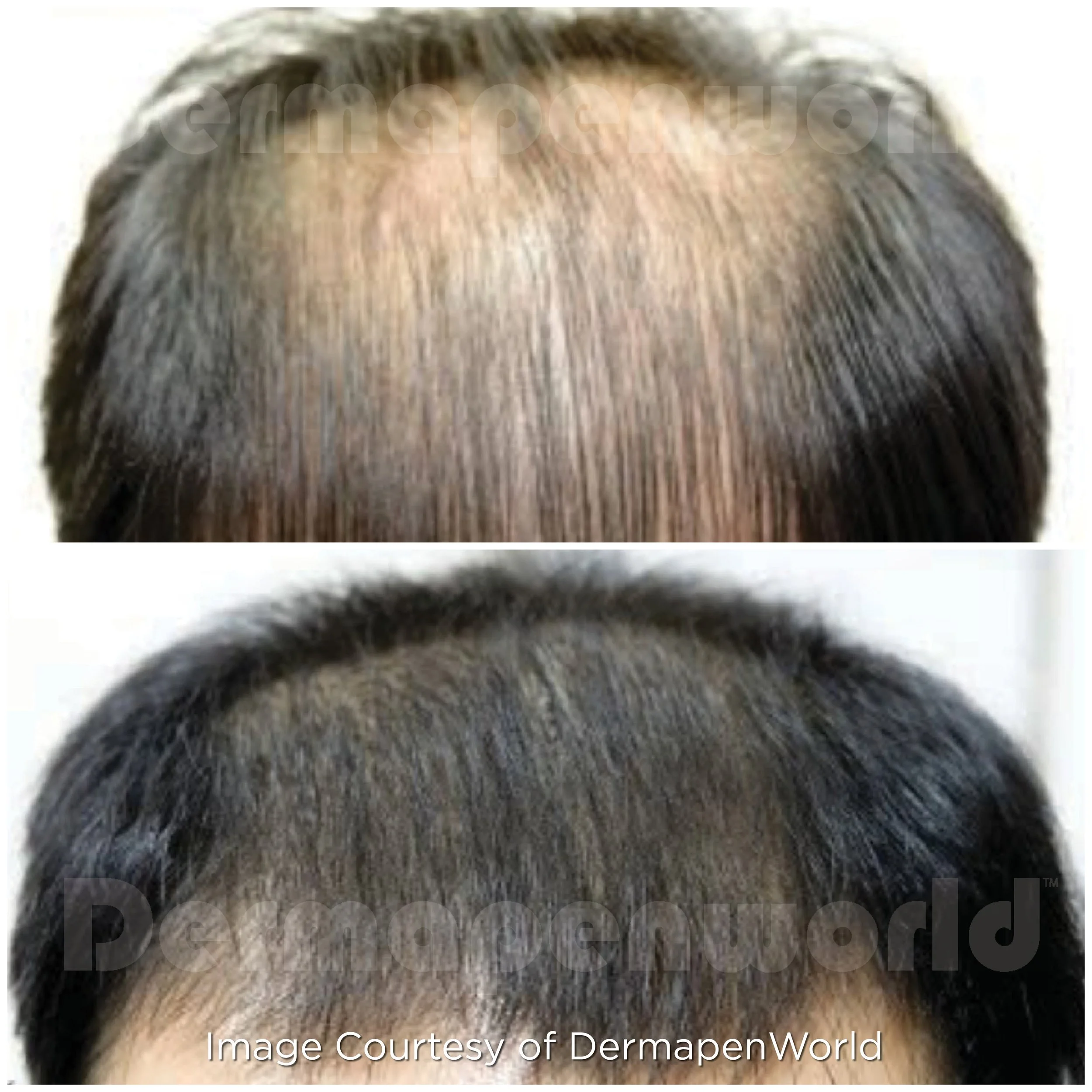 Exo-Grow Treatment Results (Copy)
