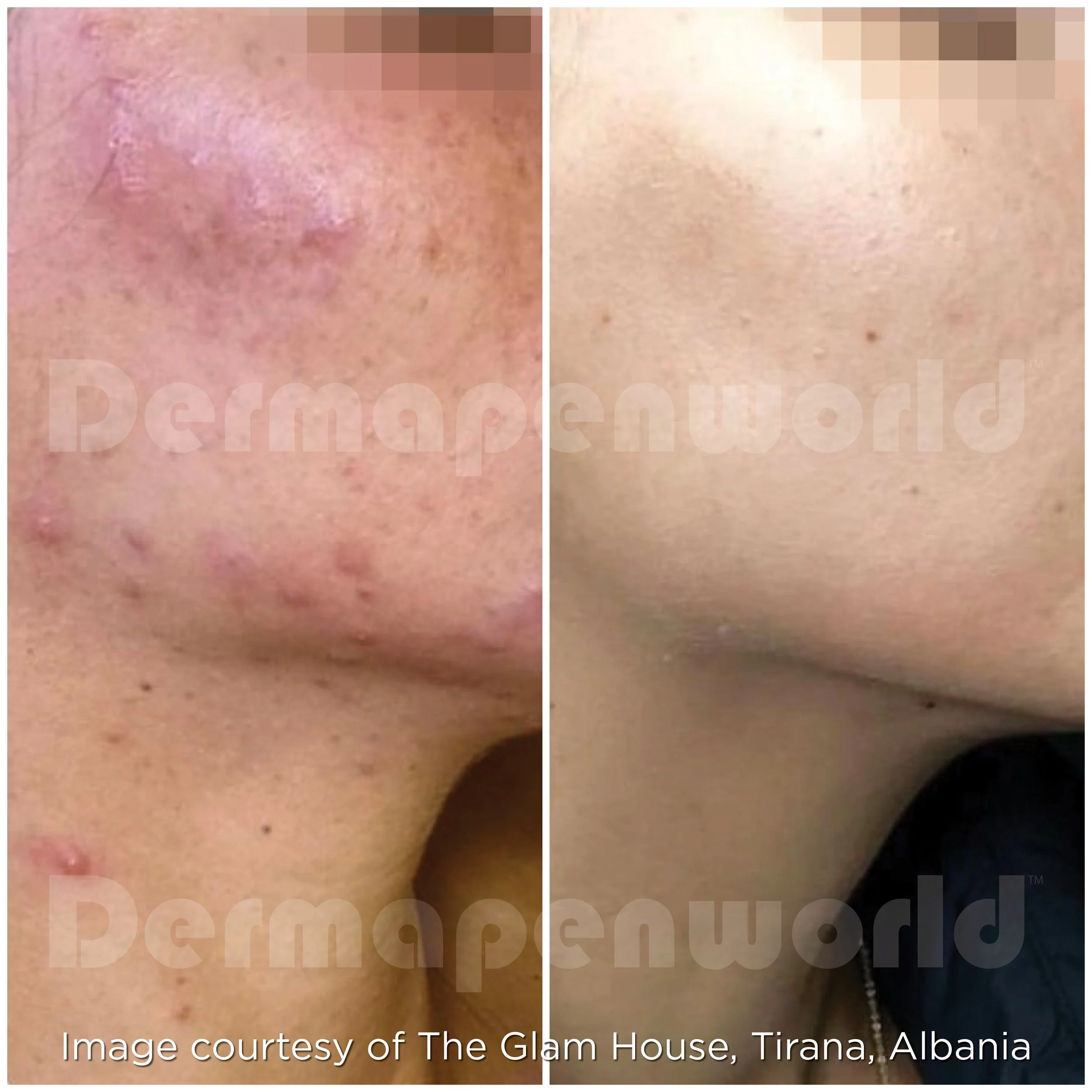 Exo-Skin Treatment Results - Acne