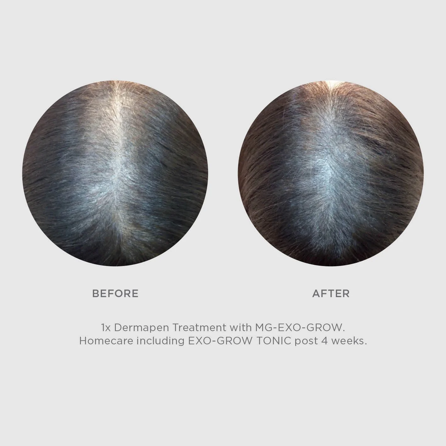 Exo-Grow Treatment Results (Copy)