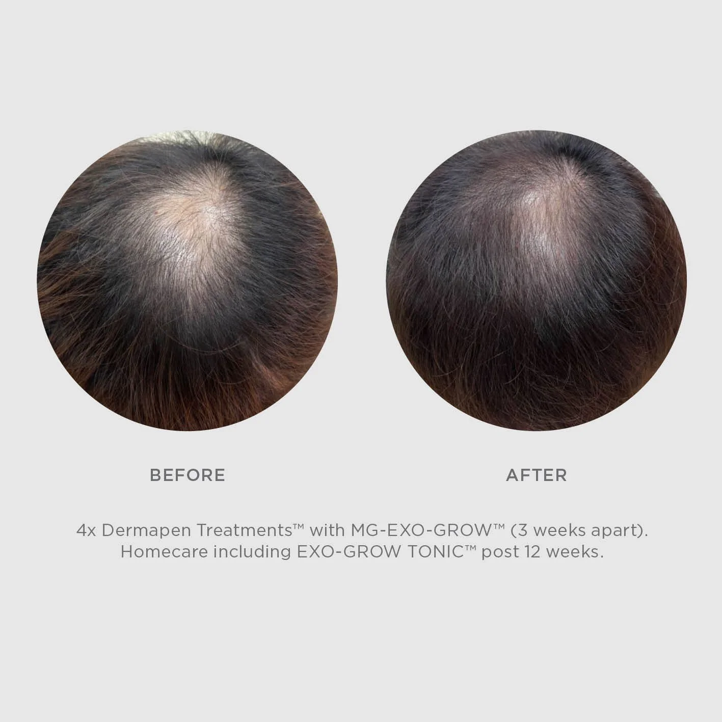 Exo-Grow Treatment Results (Copy)