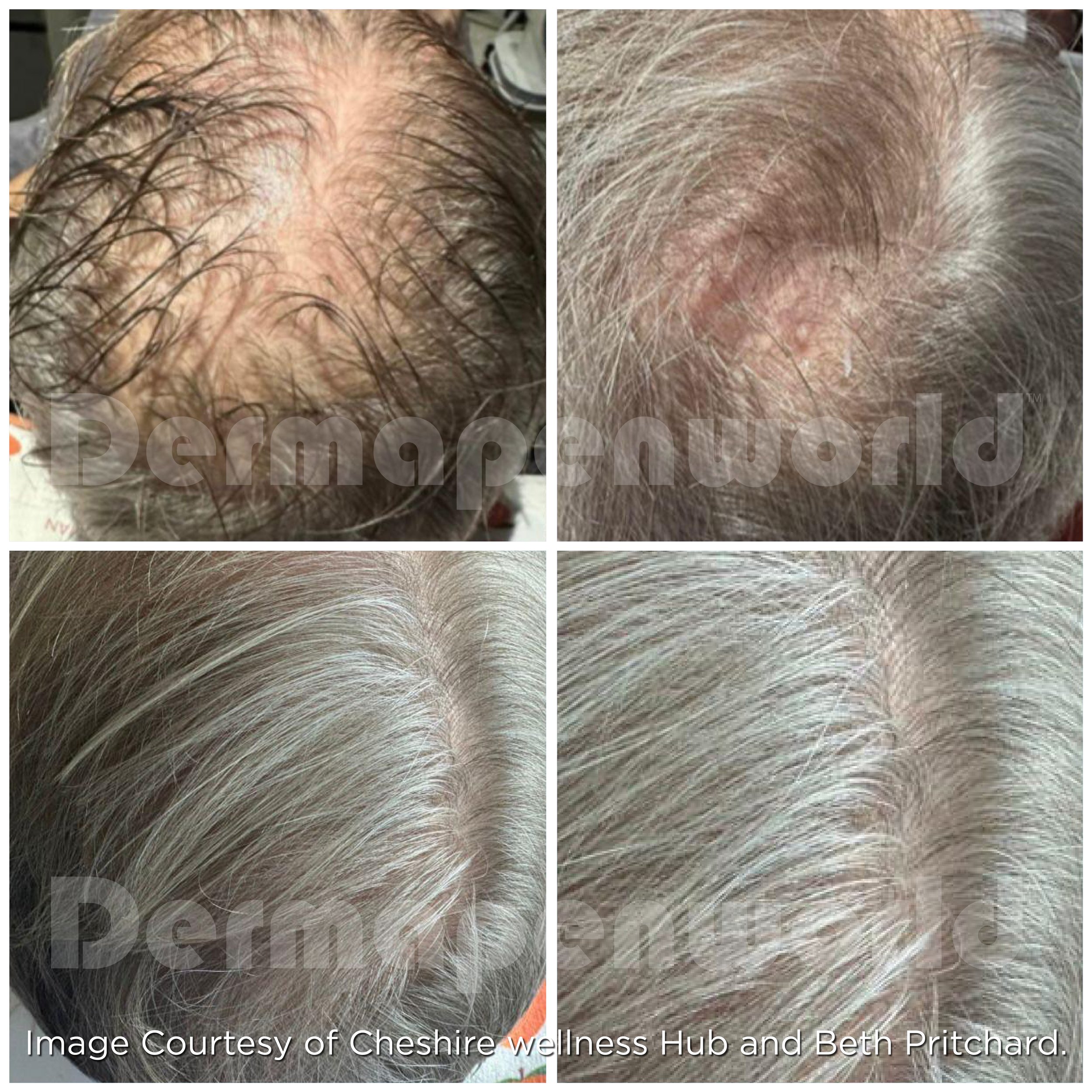Exo-Grow Treatment Results (Copy)