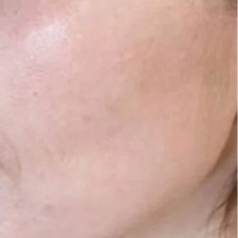 Pigmentation After