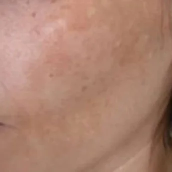 Pigmentation Before