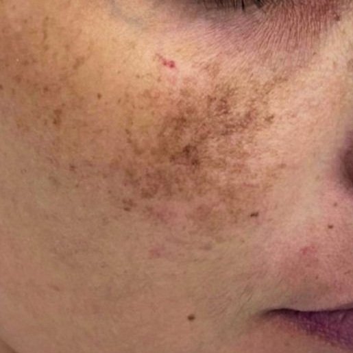 Melasma Before
