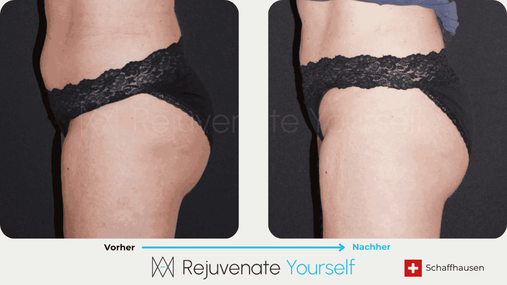 Vorher Nachher Bilddokumentation - 360° Bodyforming Bauch_10.png
