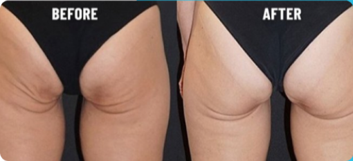 Combi-Therapy with HI-EMMS Muscle stimulation + Radiofrequency