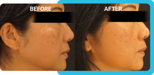 face 2 before after RejuvenateYourself.png