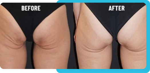 thigh before after RejuvenateYourself.png