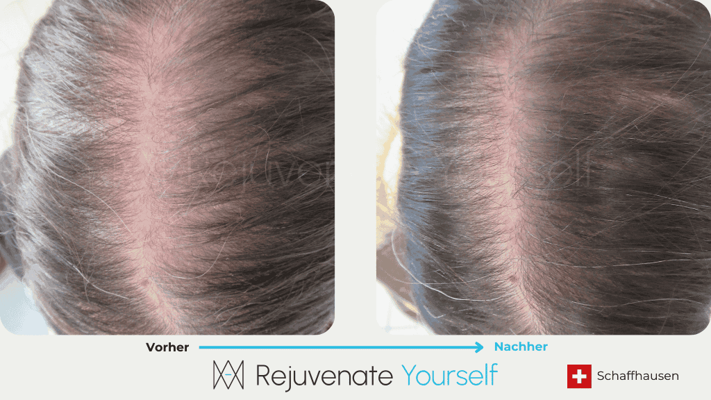 Vorher Nachher Bilddokumentation - 360° Bodyforming Haarwachstum MEDISOL mit PRP_13.png