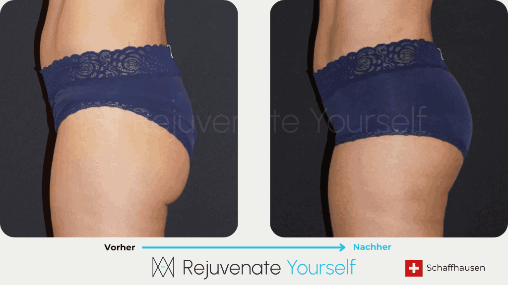 Vorher Nachher Bilddokumentation - 360° Bodyforming Bauch Beine und Po_3.png