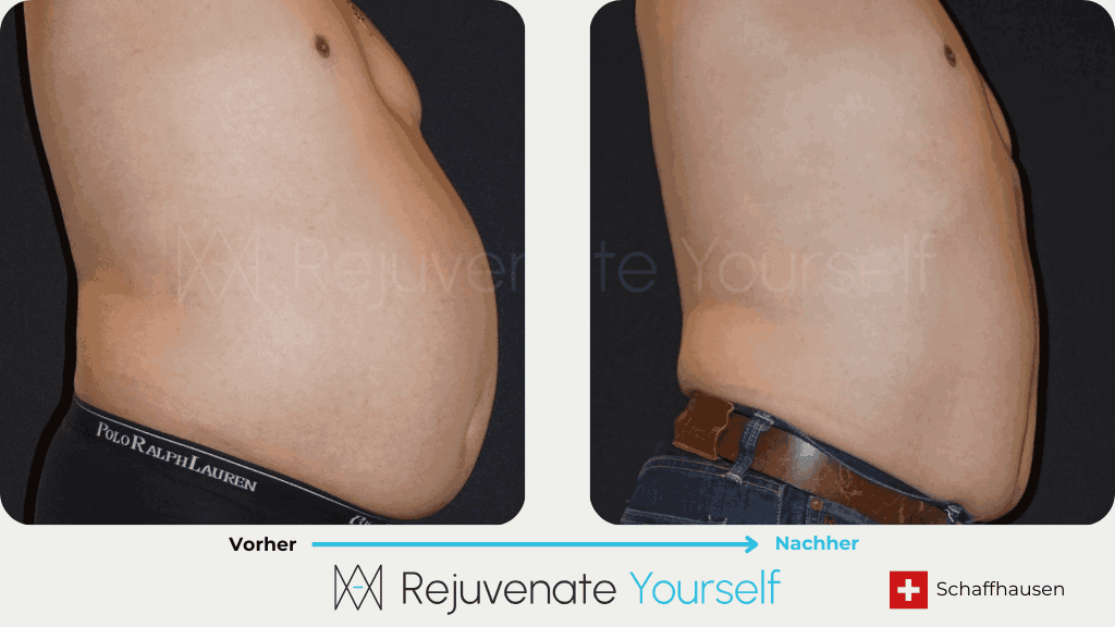 Vorher Nachher Bilddokumentation - 360° Bodyforming Bauch Mann Seitenansicht_7.png