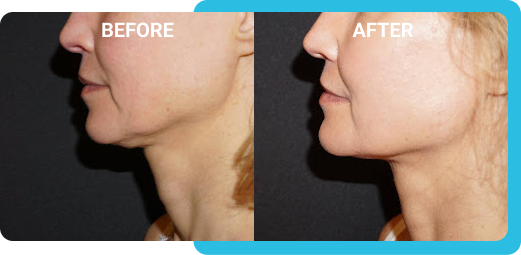 chin 2 before after RejuvenateYourself.png