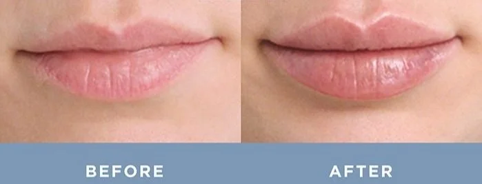 lip filler with Restylane Kyss