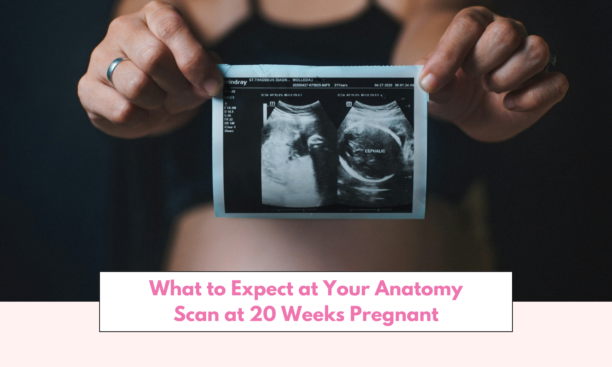 What to Expect at Your Anatomy Scan at 20 Weeks Pregnant