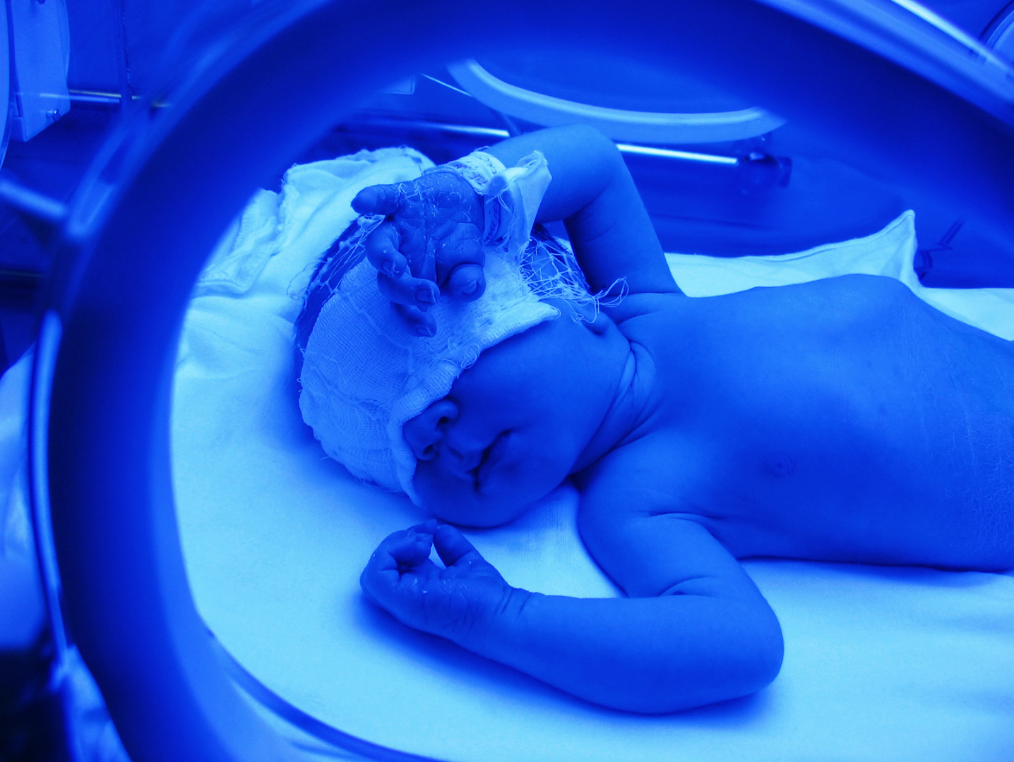 Newborn receiving phototherapy in the NICU