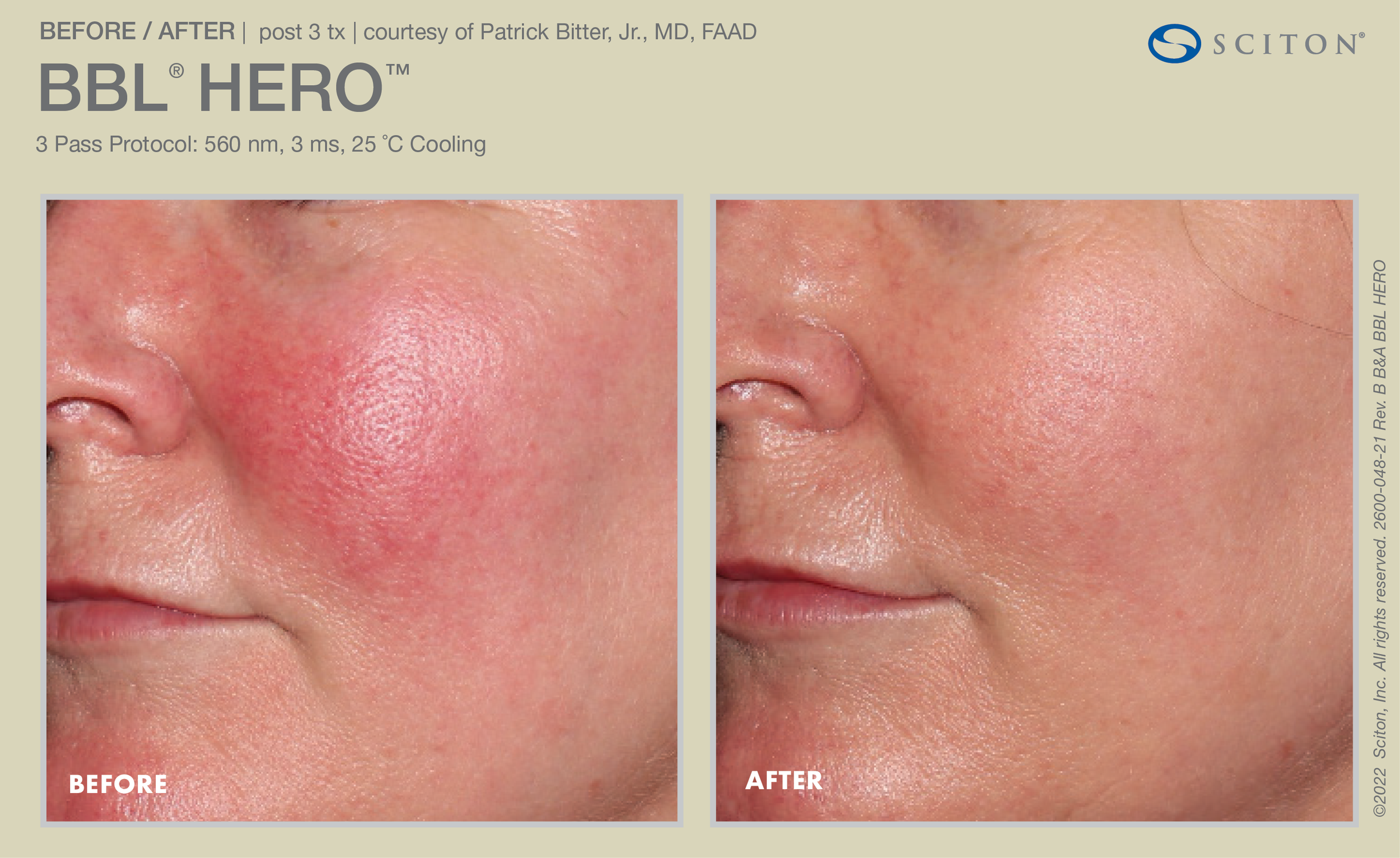 B4 & After BBL Hero.png