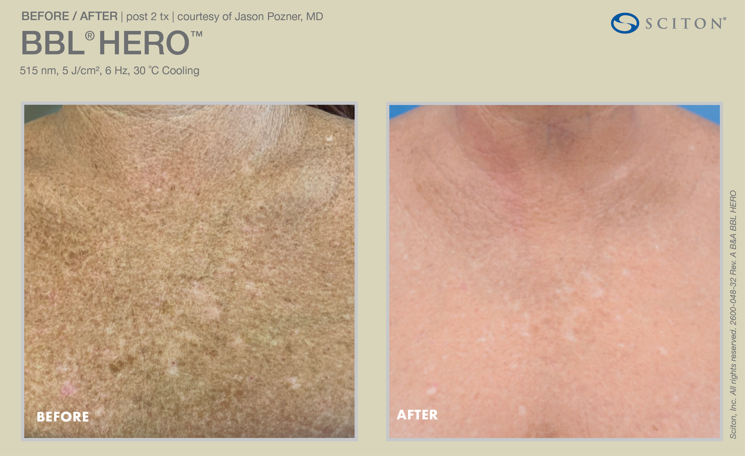 B4 & After BBL Hero 2.png