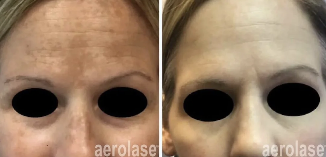 Laser Melasma treatment.jpg