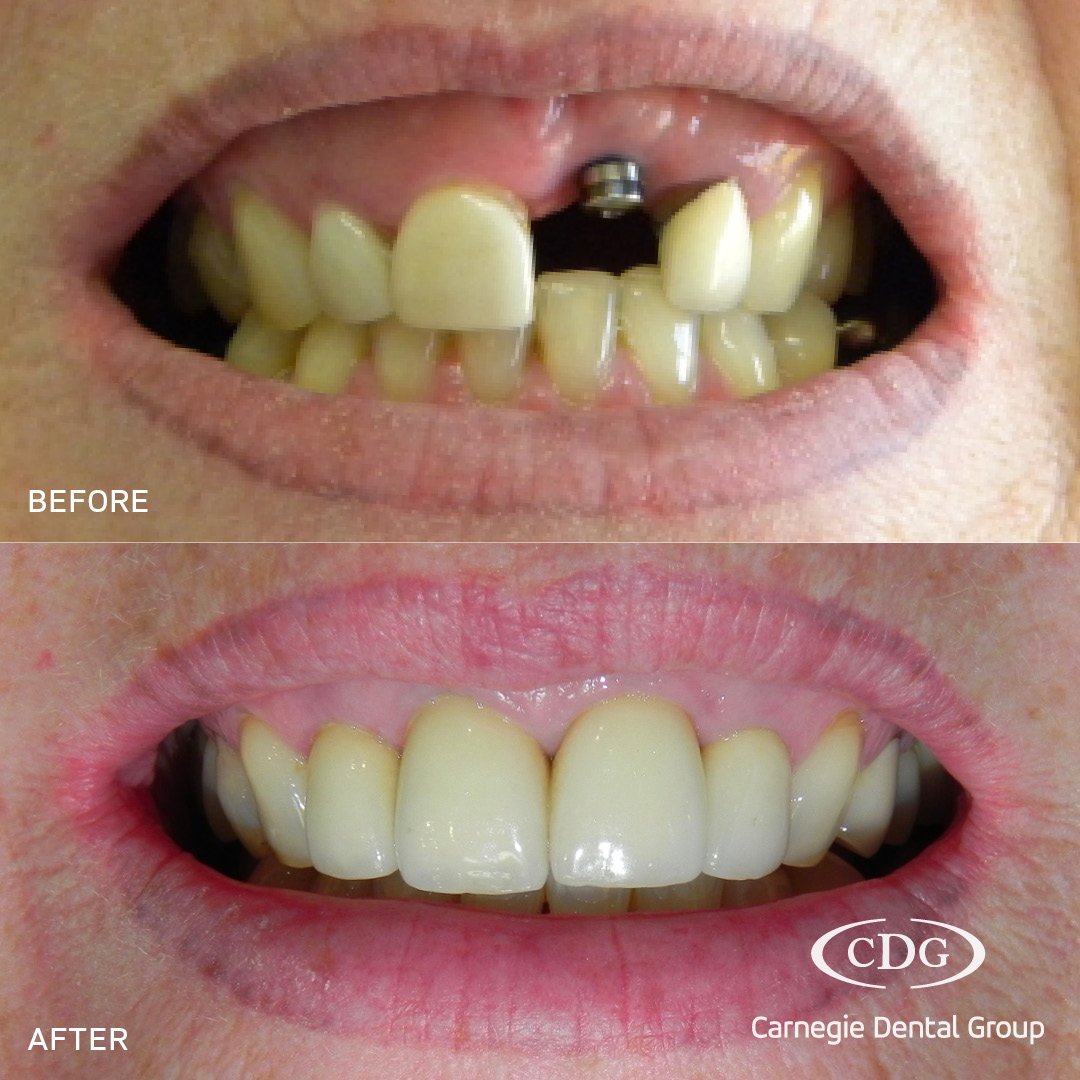 🌟 Renewed Confidence with the Power of Dentistry! 

Are you dreaming of a brighter, more confident smile? One of our happy patients experienced one of our smile makeovers some years ago, and is still happy with the results after a ten year review! ?