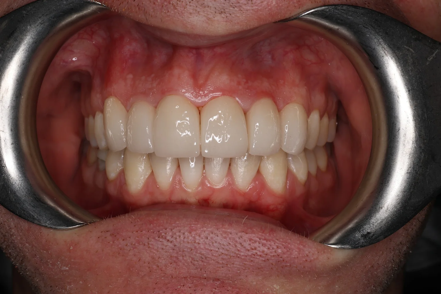 Treatment After
