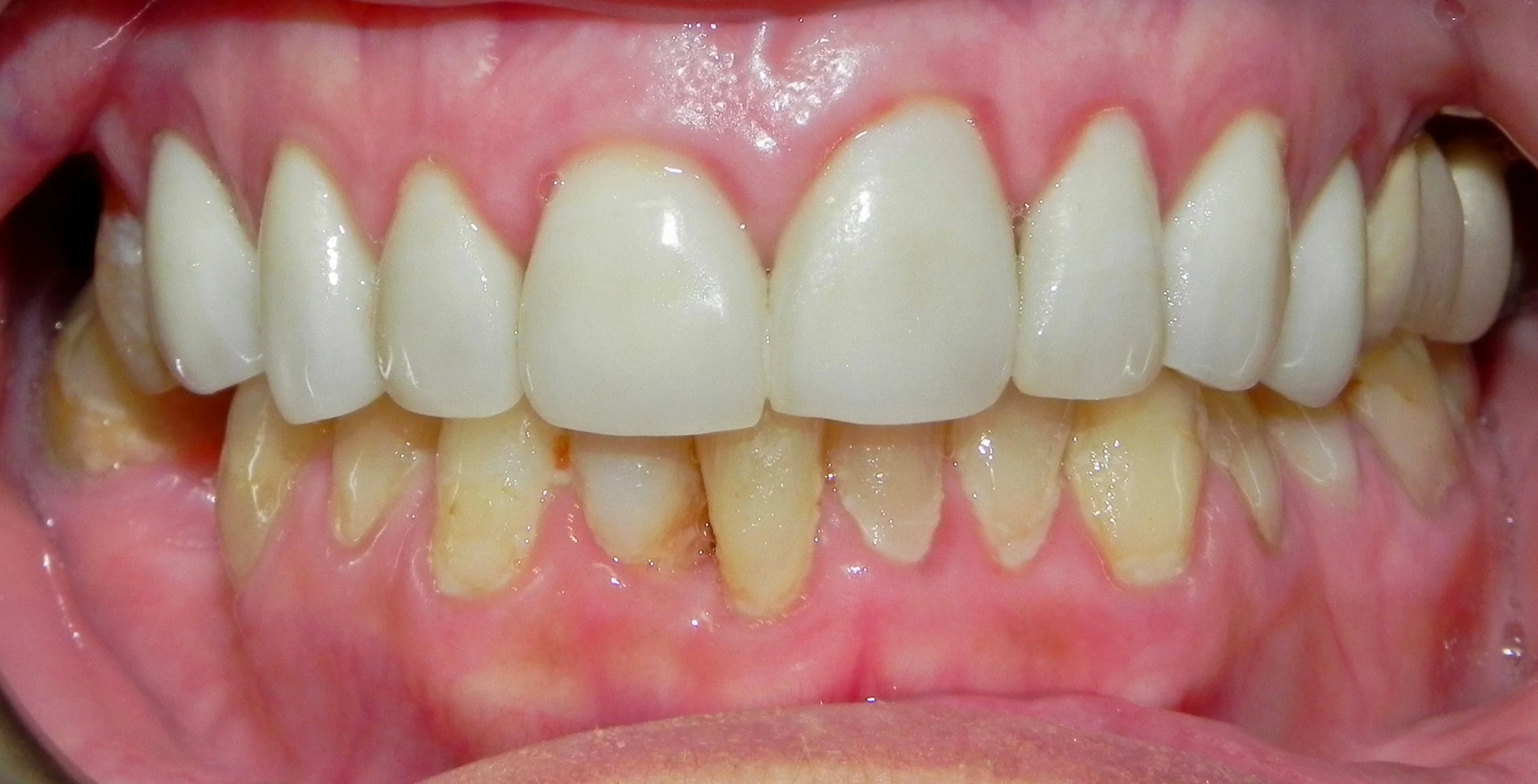 Crowns Treatment Before