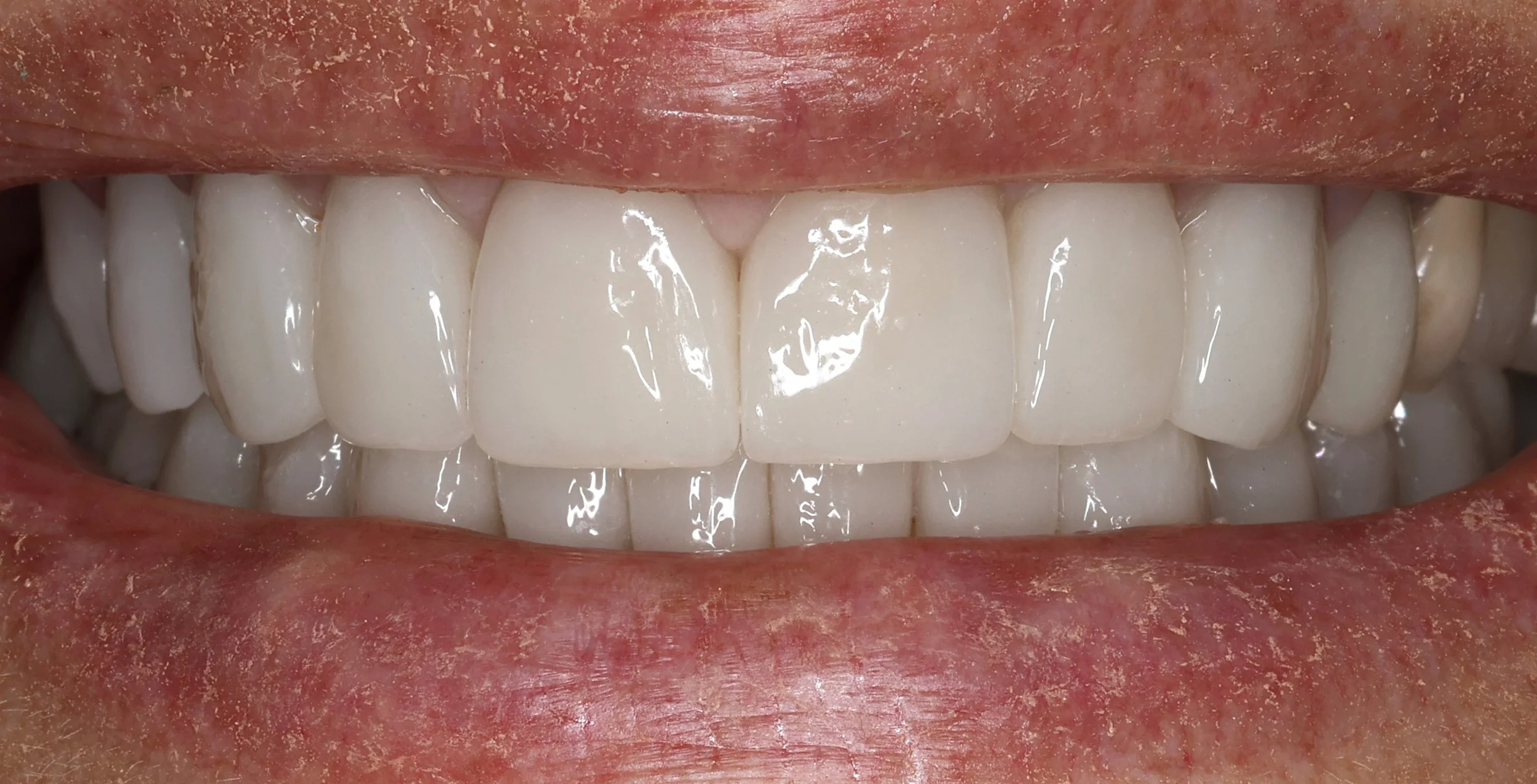 Crowns Treatment After