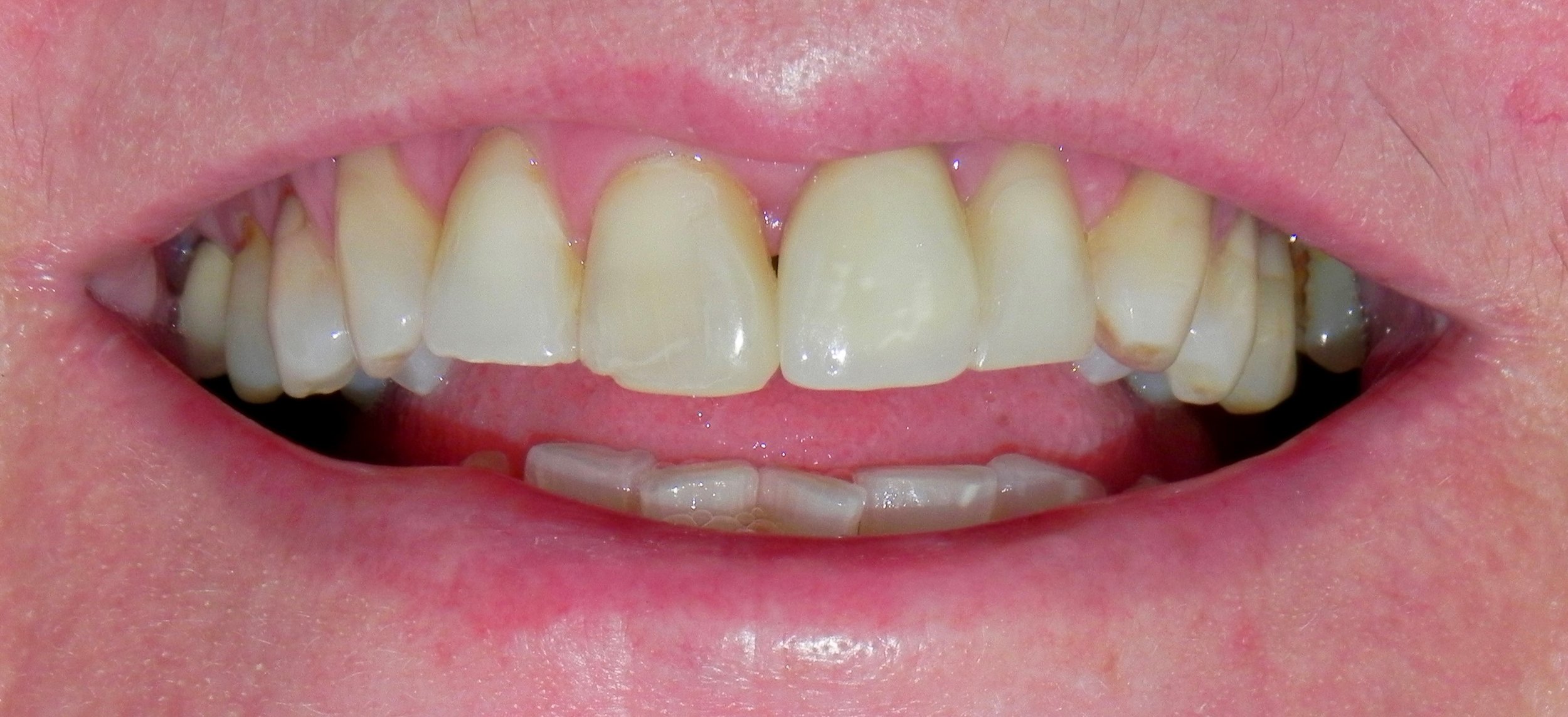 Implant Treatment After