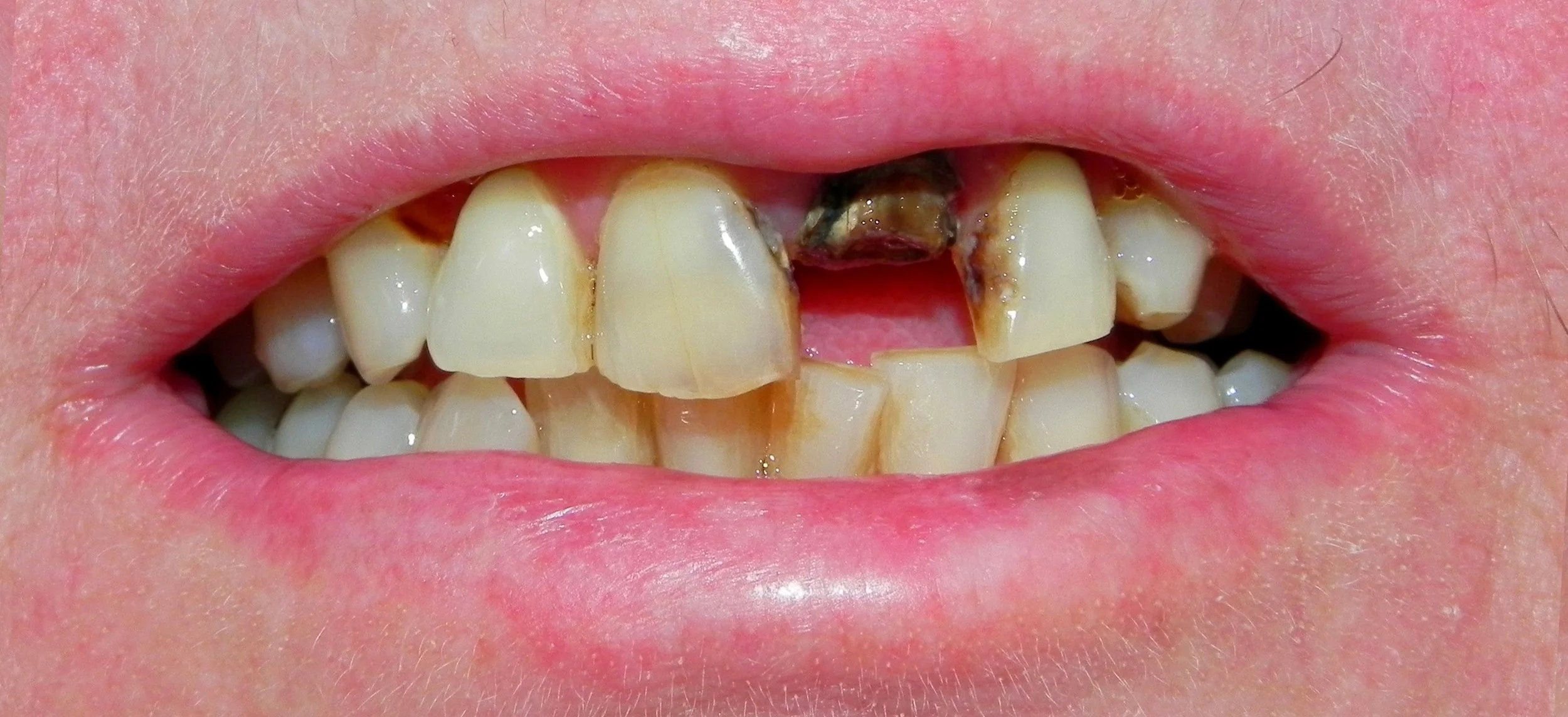 Implant Treatment Before