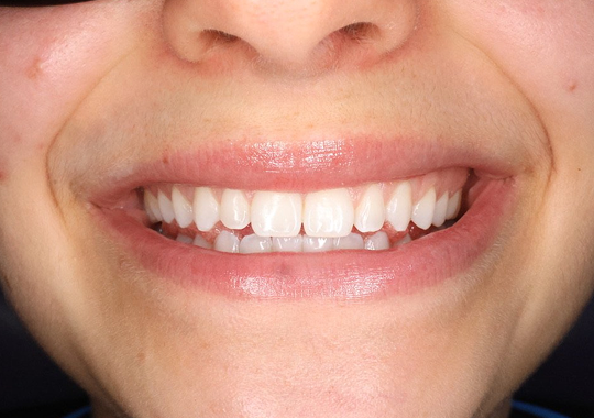 Carnegie-Dental-Before-After-Veneers-06-After 2.png
