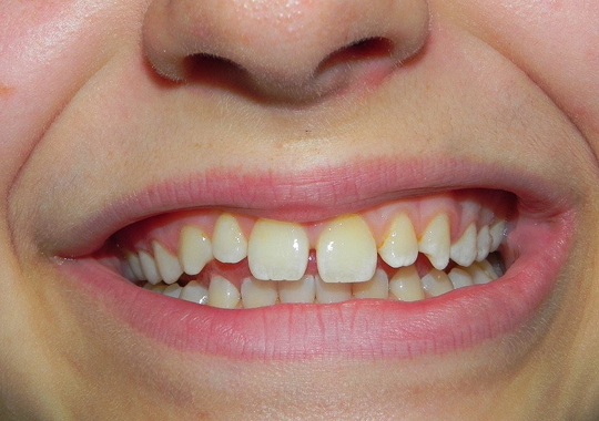 Veneer case A before.png