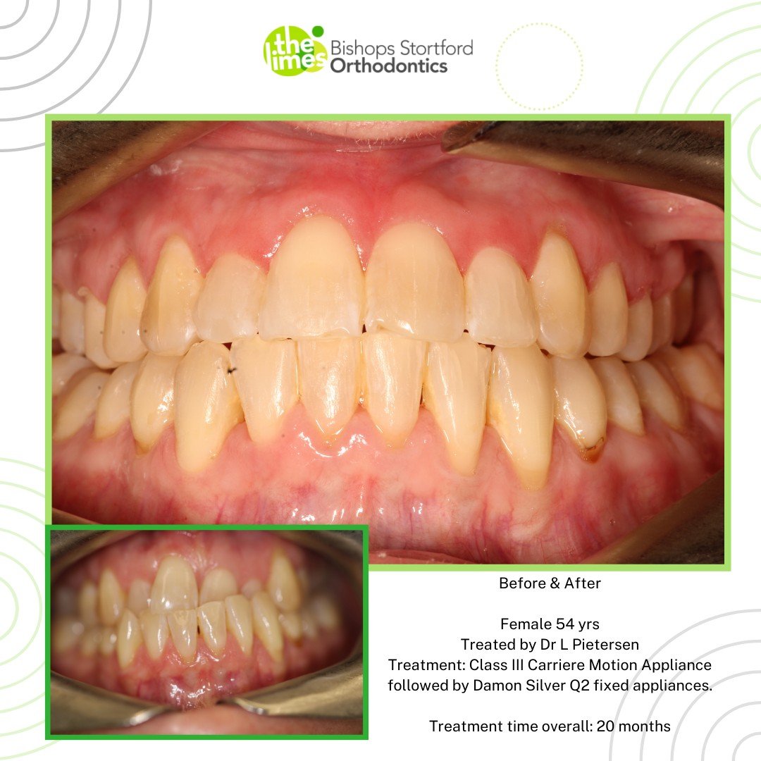 Before &amp; After 📸

Check out this amazing transformation! Treated by Dr Lorinda Pietersen and her team. 

Treatment Type: Class III Carriere Motion Appliance followed by Damon Silver Q2 Self Ligating Brackets. 
Treatment Time: 20 months

 #braces