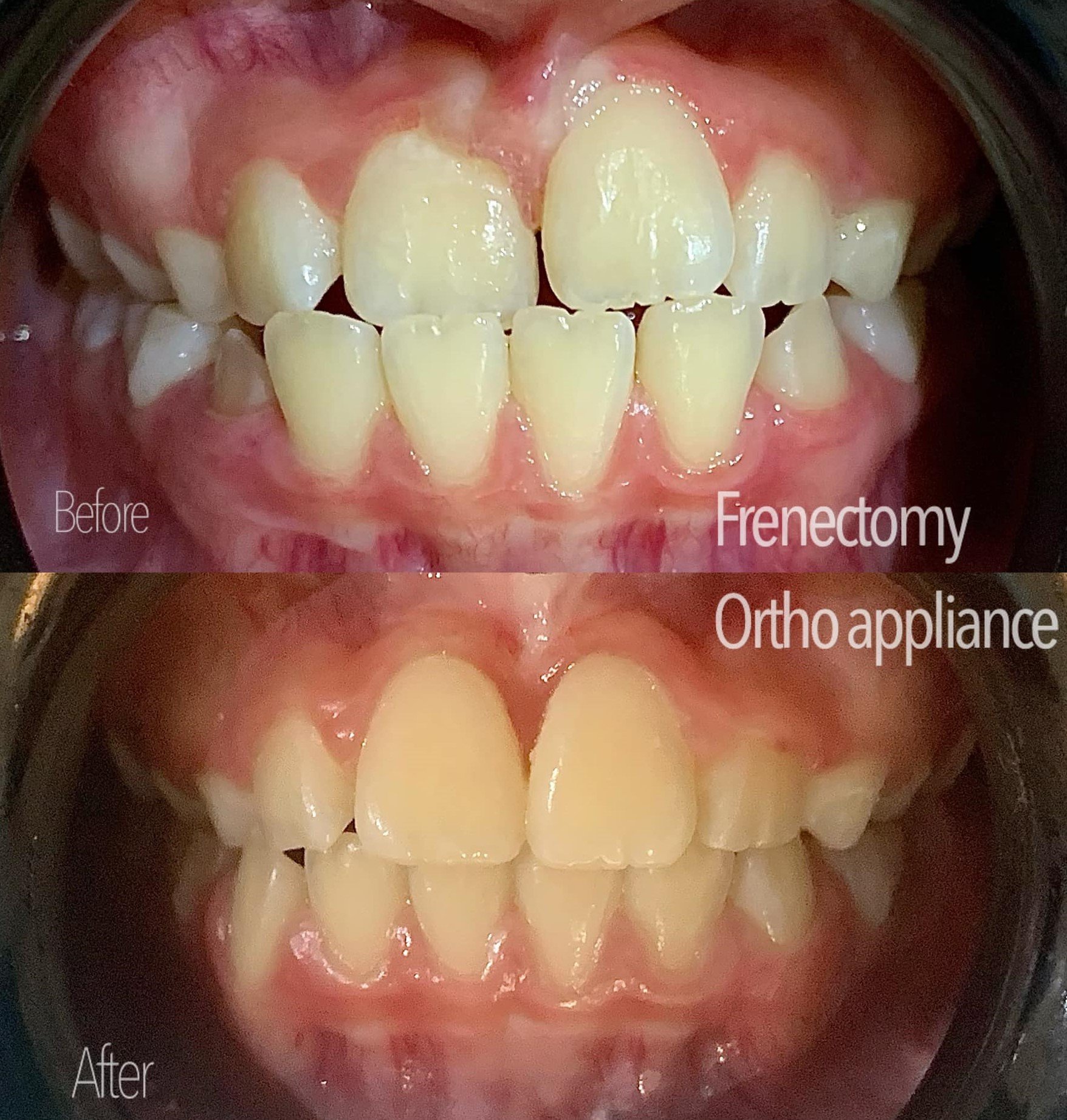 Frenectomy.jpg