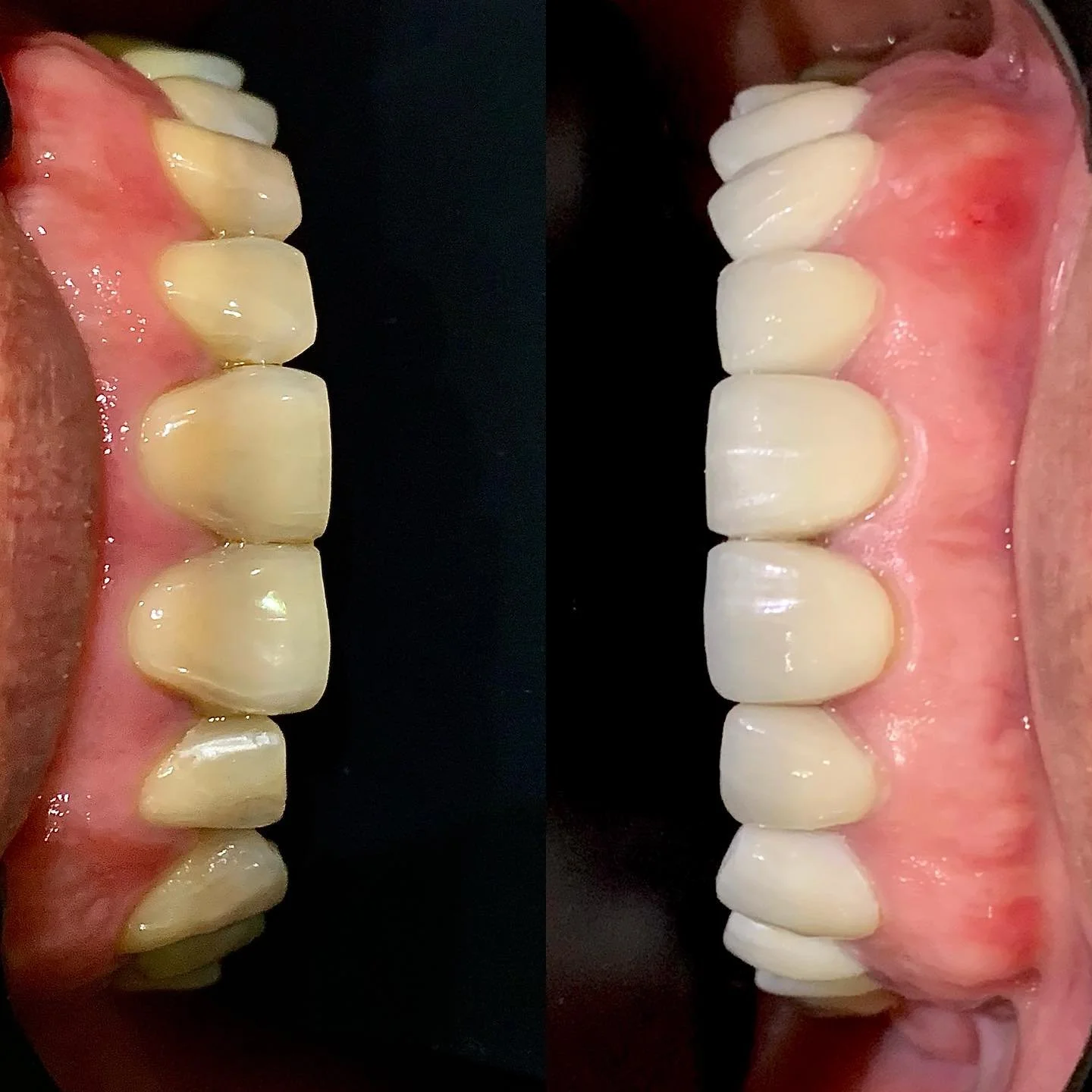 veneer_emax1.jpg