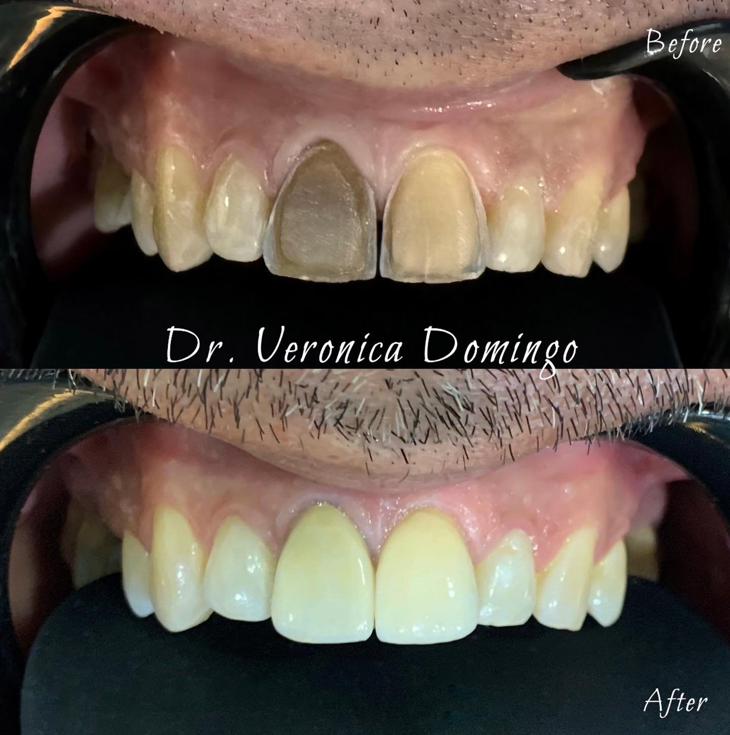 veneer_emax2.jpg