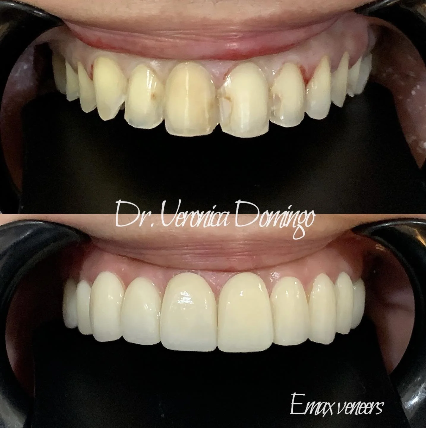 veneer_emax3.jpg